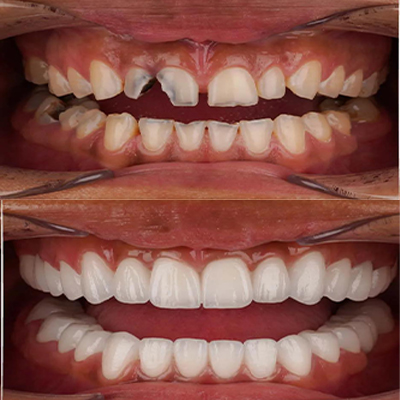 Porcelain Veneers