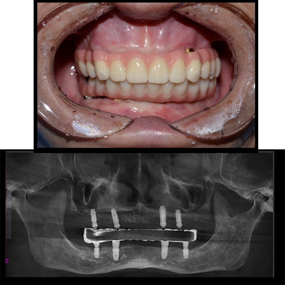 Dental Implants Before After