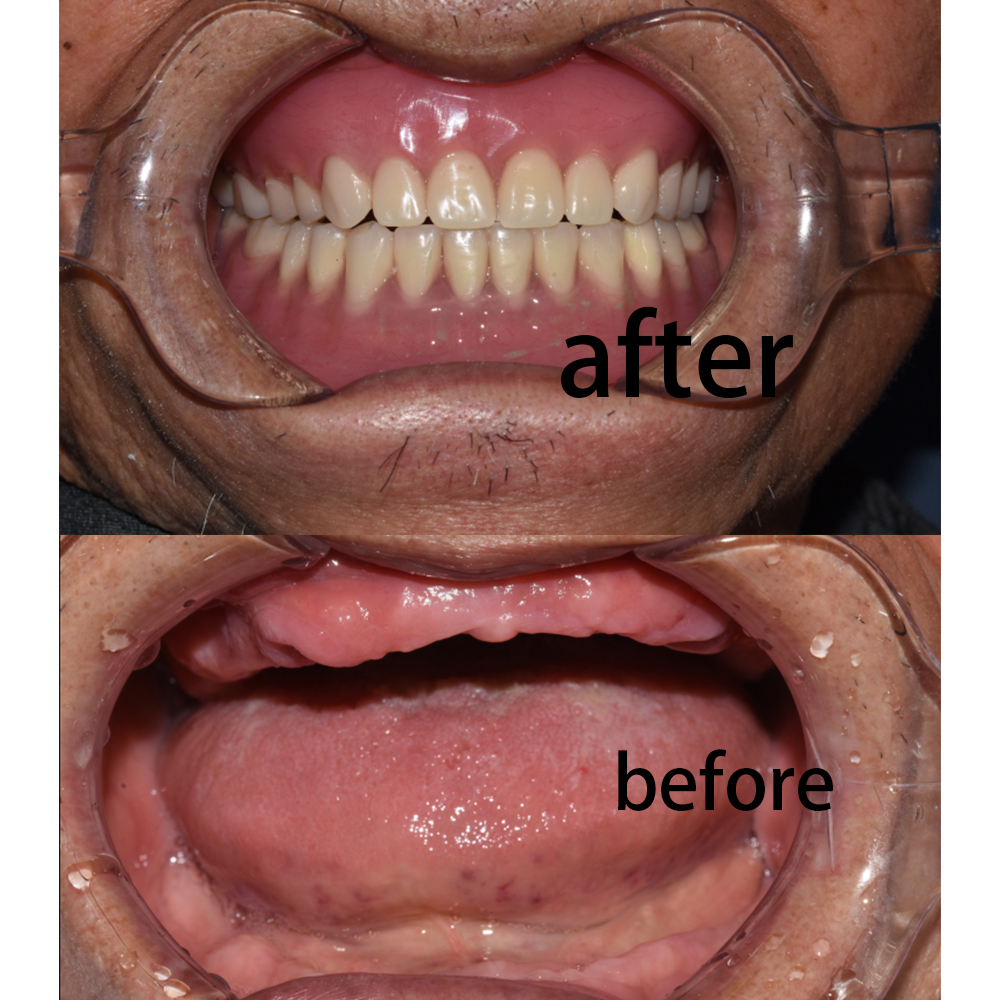 Full Mouth Before After