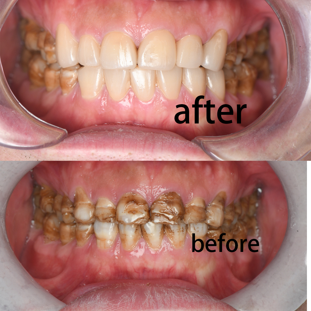 Veneers Before After