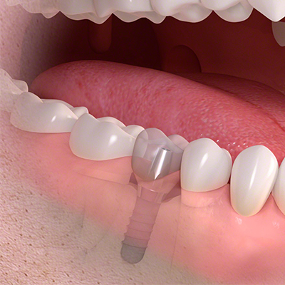 Single Tooth Implant
