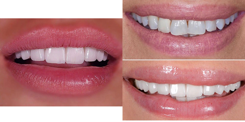 Veneers
