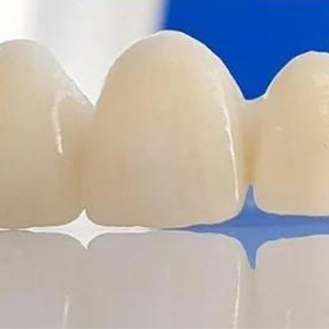 Dental Implants Procedure