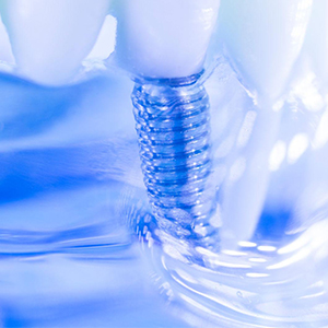 Dental Implants Procedure